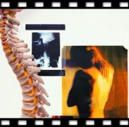 强直性脊柱炎病发有哪些特点