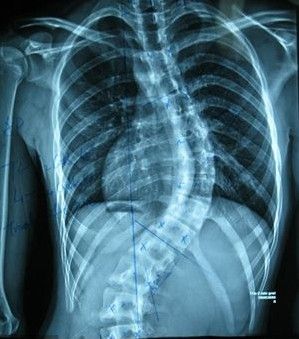 强直性脊柱炎的症状包括哪些 强直性脊柱炎的症状包括哪些